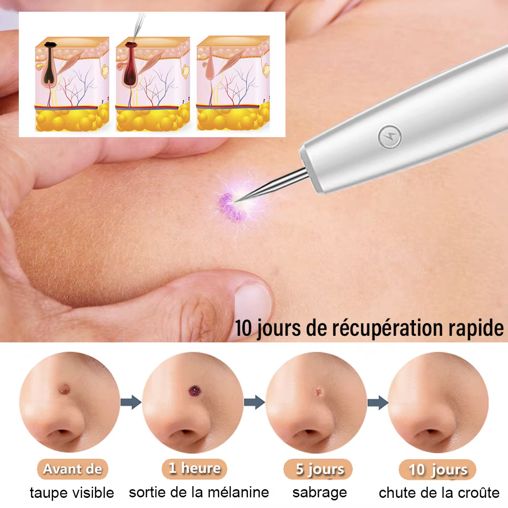 Appareil d'enlèvement des taches cutanées au plasma laser